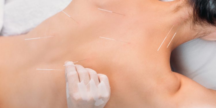 Acupuncturist targeting pressure points for anxiety, including Yintang and Spirit Gate, to promote the use of calming self-care items like fidget rings and wellness tools in the background.